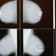 Illustration for article titled Great. Breast Cancer Prevention May Lead to Breast Cancer